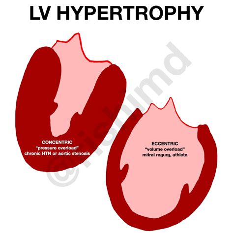 eccentric vs concentric heart failure.